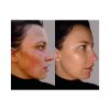 Two-Step All-Natural Acne Regimen With Bonus Zit Zapper (3 Piece Set)